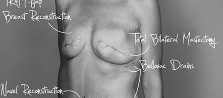cicatrices-no-son-feas-cancer-de-mama-1.jpg